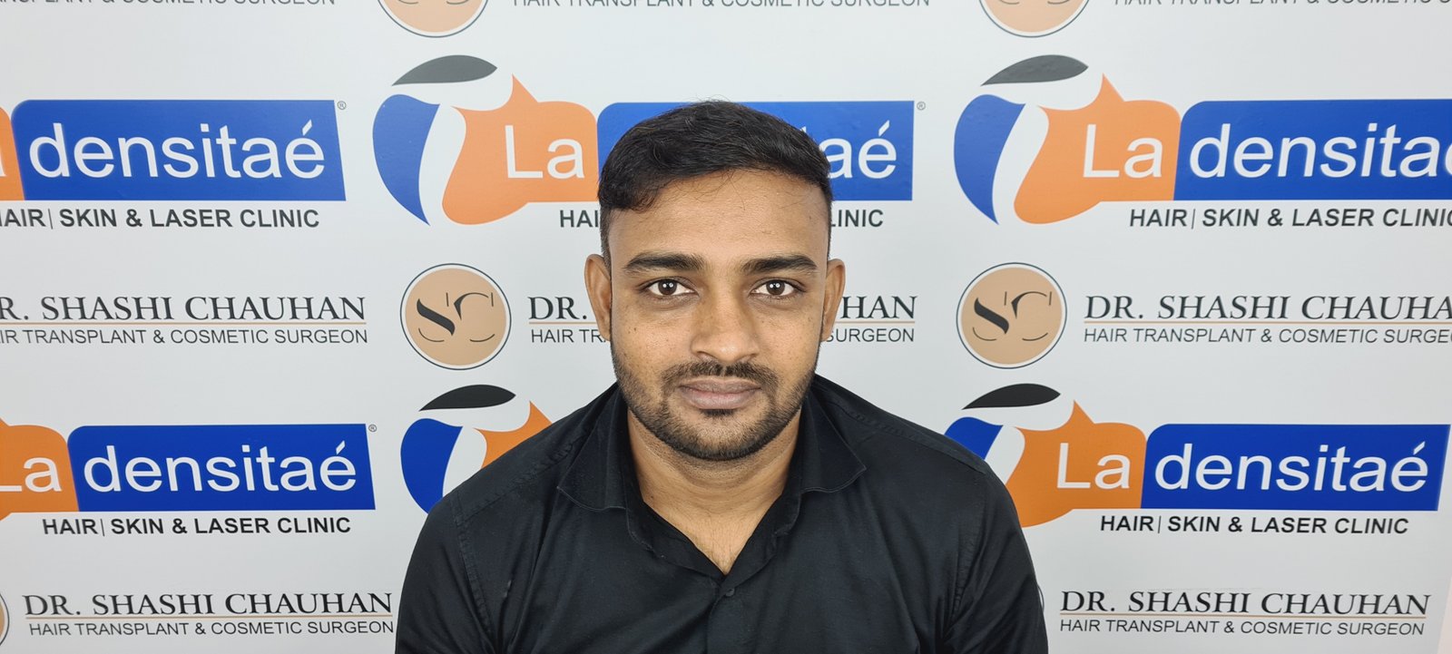 Abhay Pratap Yadav After Hair Transplant